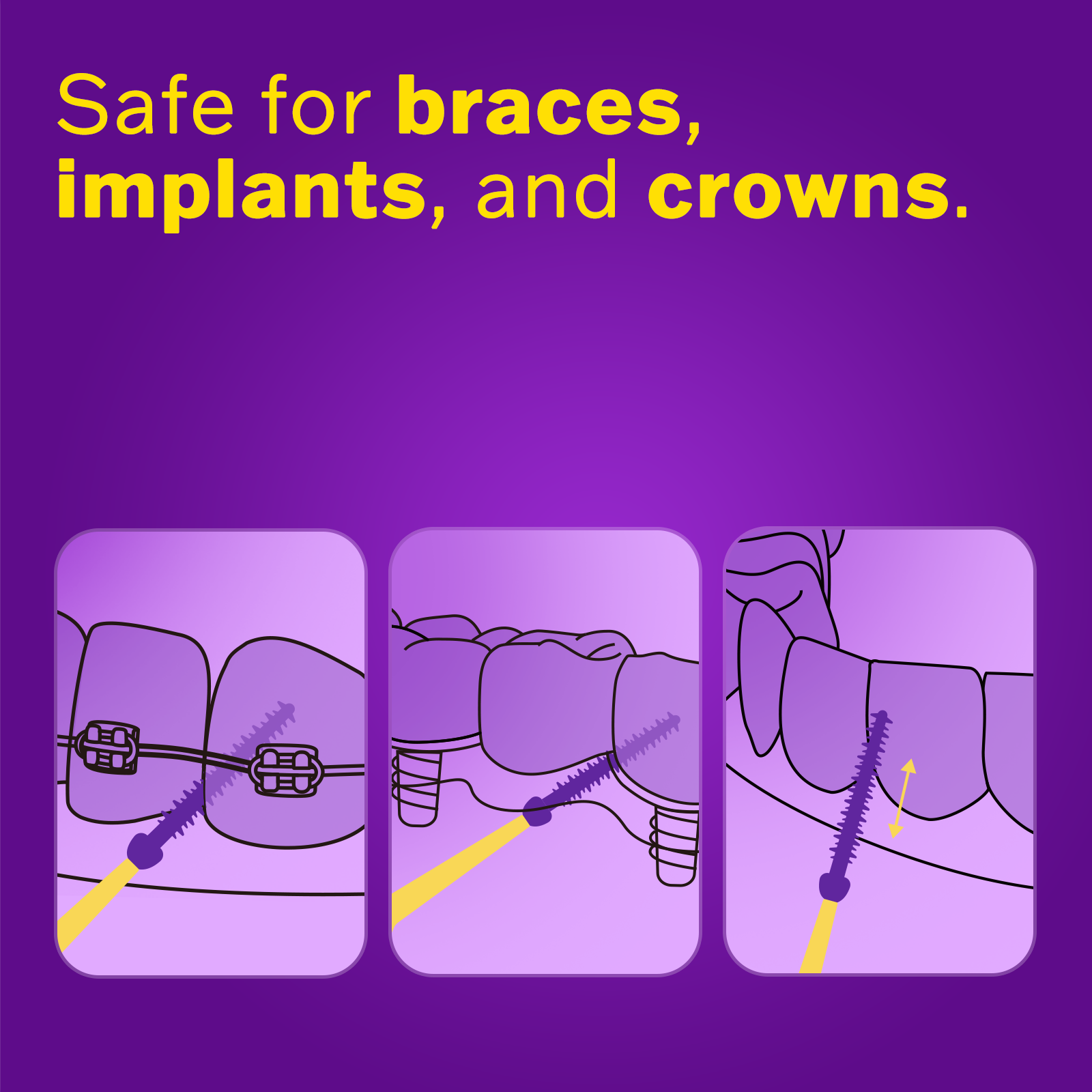 Illustrations of dental tools on a purple background with text about safety for braces, implants, and crowns.