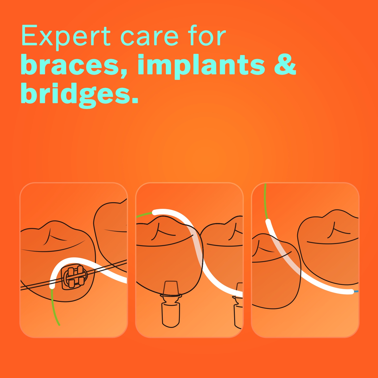 Diagram showing how to guide and curve ComboClean floss around dental bridges, implants, and braces.